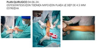 PLAN QUIRUGICO 04-06-24:
OSTESOINTESIS CON TECNICA MIPO CON PLACA LC DCP DE 4.5 MM
ESTRECHA
 