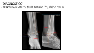 DIAGNOSTICO
• FRACTURA BIMALEOLAR DE TOBILLO IZQUIERDO DW: B
35 grados
45 grados
30 grados
4 grados
5 grados
 