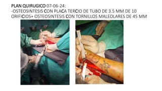 PLAN QUIRUGICO 07-06-24:
-OSTEOSINTESIS CON PLACA TERCIO DE TUBO DE 3.5 MM DE 10
ORIFICIOS+ OSTEOSINTESIS CON TORNILLOS MALEOLARES DE 45 MM
 