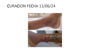 CURACION FECHA 11/06/24
 