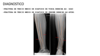 DIAGNOSTICO
-FRACTURA DE TERCIO MEDIO DE DIAFISIS DE TIBIA DERECHA AO: 42A3
-FRACTURA DE TERCIO MEDIO DE DIAFISIS DE PERONE DERECHO AO:4F2B1
15 grados
5 grados
19 grados
2 grados
 