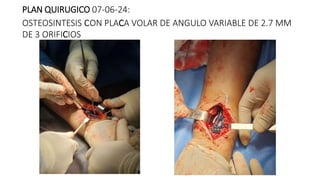 PLAN QUIRUGICO 07-06-24:
OSTEOSINTESIS cON PLACA VOLAR DE ANGULO VARIABLE DE 2.7 MM
DE 3 ORIFICIOS
 