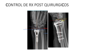 CONTROL DE RX POST QUIRURGICOS
11 grados
5 grados
10 grados
 