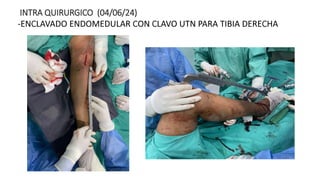 INTRA QUIRURGICO (04/06/24)
-ENCLAVADO ENDOMEDULAR CON CLAVO UTN PARA TIBIA DERECHA
 