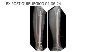 RX POST QUIRÚRGICO 04-06-24
1 GRADO
1 GRADO
1 GRADO
 