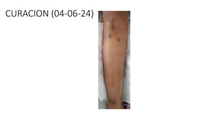 CURACION (04-06-24)
 