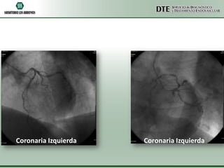 Coronaria Izquierda   Coronaria Izquierda
 