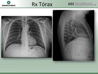 Rx Tórax
 