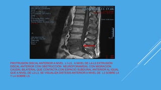 PROTRUSIÓN DISCAL ANTERIOR A NIVEL L1-L5, A NIVEL DE L4-L5 EXTRUSIÓN
DISCAL ANTERIOR CON OBSTRUCCIÓN NEUROFORAMIDAL CON MIGRACIÓN
CAUDAL BILATERAL QUE CONTACTA CON ESPACIO SUBDURAL ANTERIOR AL IGUAL
QUE A NIVEL DE L2-L3, SE VISUALIZA DISTESIS ANTERIOR A NIVEL DE L3 SOBRE L4
Y L4 SOBRE L5.
 