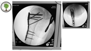 Functional and Radiological Outcomes of Proximal Humerus Fractures ...