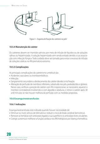 Ministério

da

Saúde

Figura 1 – Esquema de fixação dos cateteres na pele1
10.5.4 Manutenção do cateter
Os cateteres devem ser mantidos pérvios por meio de infusão de líquidos ou de soluções
salinas ou heparinizadas. A solução heparinizada vem sendo evitada devido a sua associação com infecção fúngica. Todo cuidado deve ser tomado para evitar o excesso de infusão
de soluções sódicas no RN prematuro extremo.
10.5.5 Complicações
As principais complicações do cateterismo umbilical são:
•	 Acidentes vasculares ou tromboembólicos.
•	 Infecção.
•	 Sangramento secundário a deslocamento do cateter devido à má fixação.
•	 Alteração de perfusão de membros inferiores, sobretudo nos pés, pododáctilos e glúteos.
Nesse caso, verificar a posição do cateter com RX e reposicionar, se necessário; aquecer o
membro contralateral envolvendo-o com algodão e ataduras; e retirar o cateter após 30
a 60 minutos se não houver melhora da perfusão com as medidas propostas.
10.6 Exsanguineotransfusão
10.6.1 Indicações
Exsanguineotransfusão está indicada quando houver necessidade de:
•	 Diminuir os níveis séricos de bilirrubina e reduzir o risco de lesão cerebral (kernicterus).
•	 Remover as hemácias com anticorpos ligados a sua superfície e os anticorpos livres circulantes.
•	 Corrigir a anemia e melhorar a função cardíaca nos RN hidrópicos por doença hemolítica.

20

Atenção à Saúde do Recém-Nascido
Guia para os Profissionais de Saúde

 