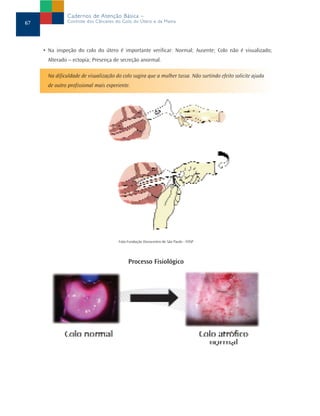 Cadernos de Atenção Básica –
67              Controle dos Cânceres do Colo do Útero e da Mama




     • Na inspeção do colo do útero é importante verificar: Normal; Ausente; Colo não é visualizado;
       Alterado – ectopia; Presença de secreção anormal.

       Na dificuldade de visualização do colo sugira que a mulher tussa. Não surtindo efeito solicite ajuda
       de outro profissional mais experiente.




                                       Foto:Fundação Oncocentro de São Paulo - FOSP




                                            Processo Fisiológico
 