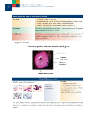 Cadernos de Atenção Básica –
73                   Controle dos Cânceres do Colo do Útero e da Mama




     Alguns motivos que poderão gerar amostra rejeitada:
     Na coleta                                     • Escassez de células na amostra;
                                                   • Excesso de material: esfregaços espessos, dificultando a leitura no microscópio;
                                                   • Presença de hemácias ou leucócitos em grande quantidade;
                                                   • Presença de material de contaminação: vaselina, pomadas, etc.
     Na fixação                                    Má fixação: erro no procedimento após a coleta geralmente por demora na
                                                   fixação, excesso ou escassez de fixador.

     No laboratório                                Problemas na coloração: corantes de má qualidade, mal preparados. A
                                                   fixação inadequada também prejudica a coloração, dificultando a obser-
                                                   vação microscópica.


        Diagnóstico Descritivo

                                 Células que podem aparecer na coleta citológoca




                                                          Adequabilidade da amostra
     Epitélios representados na amostra                                                               Atencão:
                                                                                                      • É informação obrigatória
                                                                     – Escamoso
                                                                     – Glandular                      • A avaliação da adequabilidade
                                                                     – Metaplástico                   no que diz respeito à representação
                                                                                                      da JEC, passa a ser de
                                                                                                      responsabilidade do ginecologista




     Nota: Observe-se que os aspectos de representatividade celular constam de caixa própria, onde será dada a informação (obrigatória) dos eitélios
     que estão representados na amostra. A definição de adequabilidade pela representatividade passa a ser de exclusiva competência do responsável
     pela paciente que deverá levar em consideração as condições próprias de cada uma (idade, estado menstrual, limitações anatômicas, objetivo do
     exame etc.)
 