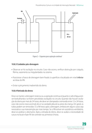 Atenção à Saúde do Recém-Nascido
Guia para os Profissionais de Saúde
29
Procedimentos Comuns na Unidade de Internação Neonatal 10 Capítulo
RN
Fechado
20 cm
10 a
Aspiração
Figura2–Esquemaparaaspiraçãocontínua2
10.8.3 Cuidados pós-drenagem
•	Observar se há oscilação no circuito. Caso não ocorra, verificar obstrução por coágulo,
fibrina, vazamento ou irregularidades no sistema.
•	Posicionar o frasco de drenagem bem fixado à superfície e localizado em nível inferior
ao tórax do RN.
•	Evitar o pinçamento inadvertido do dreno.
10.8.4 Retirada do dreno
Deve-se manter a drenagem torácica ou a aspiração contínua enquanto o selo d’água esti-
ver borbulhando e se forem percebidas oscilações no circuito. Quando não houver oscila-
ção do dreno por mais de 24 horas, ele deve ser clampeado e removido entre 12 e 24 horas,
caso não ocorra novo acúmulo de ar na cavidade pleural ou piora da criança. Em geral, os
tubos podem ser removidos 72 a 96 horas após a drenagem, embora em alguns casos seja
necessária a sua manutenção por mais tempo. Se o RN estiver em assistência ventilatória,
deve-se acelerar o desmame. Após a retirada do dreno, deve-se avaliar a necessidade de
sutura no local e fazer RX de controle nas primeiras 6 horas.
 