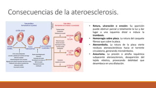 Consecuencias de la ateroesclerosis.
• Rotura, ulceración o erosión: Su aparición
puede obstruir parcial o totalmente la luz y dar
lugar a una isquemia distal e induce la
trombosis.
• Hemorragia sobre placa. La rotura del casquete
fibroso que cubre la placa.
• Ateroembolia. La rotura de la placa vierte
residuos ateroescleróticos hacia el torrente
circulatorio, generando microémbolos.
• Aneurisma. La presión o atrofia isquémica
subyacente ateroesclerosis, desaparición del
tejido elástico, provocando debilidad que
desemboca en una dilatación.
 