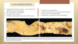  PLACA ATEROESCLERÓTICA
• Engrosamiento de la íntima + acumulación de
lípidos (procesos esenciales).
• De color blanco amarillento.
• Ocupan la luz arterial.
• Trombos superpuestos de color pardo rojizo
• Lesiones son parcheadas
• Suelen afectar sólo a una porción de la pared
• Rara vez son circunferenciales
• Desarrollo y crecimiento lento (décadas)
 