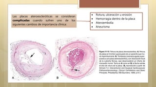 Las placas ateroescleróticas se consideran
complicadas cuando sufren uno de los
siguientes cambios de importancia clínica:
 Rotura, ulceración u erosión
 Hemorragia dentro de la placa
 Ateroembolia
 Aneurisma
 