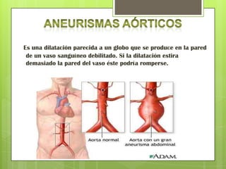 Es una dilatación parecida a un globo que se produce en la pared
 de un vaso sanguíneo debilitado. Si la dilatación estira
 demasiado la pared del vaso éste podría romperse.
 