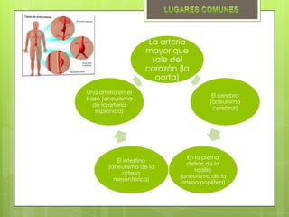 La arteria
                    mayor que
                      sale del
                    corazón (la
                       aorta)
Una arteria en el
                                        El cerebro
bazo (aneurisma
                                       (aneurisma
  de la arteria
                                        cerebral)
   esplénica)




                              En la pierna
           El intestino
                              detrás de la
        (aneurisma de la
                                  rodilla
              arteria
                            (aneurisma de la
          mesentérica)
                            arteria poplítea)
 