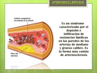Es un síndrome
caracterizado por el
      depósito e
    infiltración de
 sustancias lipídicas
en las paredes de las
arterias de mediano
 y grueso calibre. Es
la forma más común
 de arteriosclerosis
 