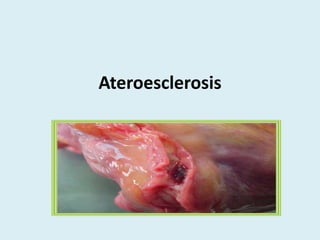 Ateroesclerosis
 