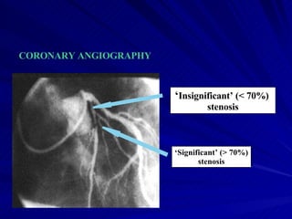 ‘ Significant’ (> 70%) stenosis ‘ Insignificant’ (< 70%)  stenosis CORONARY ANGIOGRAPHY 