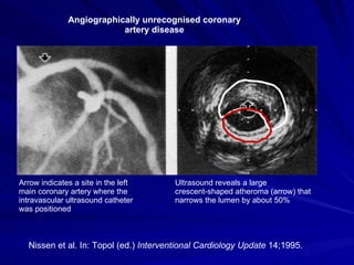 Angiographically unrecognised coronary artery disease Nissen et al. In: Topol (ed.)  Interventional Cardiology Update  14;1995. Ultrasound reveals a large crescent-shaped atheroma (arrow) that narrows the lumen by about 50% Arrow indicates a site in the left main coronary artery where the intravascular ultrasound catheter was positioned 