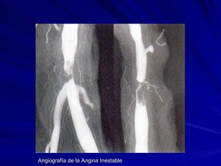 Angiografía de la Angina Inestable 