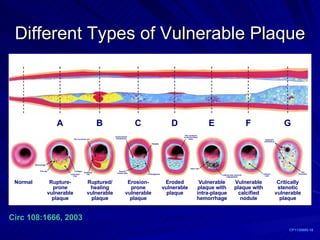 Different Types of Vulnerable Plaque CP1130695-18 Circ 108:1666, 2003 A B C D E F G Rupture- prone vulnerable plaque Ruptured/ healing vulnerable plaque Erosion- prone vulnerable plaque Eroded vulnerable plaque Vulnerable plaque with intra-plaque hemorrhage Vulnerable plaque with calcified nodule Critically stenotic vulnerable plaque Normal Macrophage Thin cap Large lipid core Collagen Ruptured cap Non-occlusive clot Smooth muscle cells Dysfunctional endothelium Platelets Proteoglycans Non-occlusive mural thrombus/ fibrin Intact cap Leaking vasa vasorum/ angiogenesis Calcium node Extensive calcification Old thrombus 