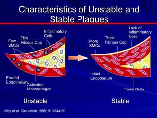 Characteristics of Unstable and Stable Plaques Thin  Fibrous Cap Inflammatory  Cells Few SMCs Unstable Eroded Endothelium Activated Macrophages Thick Fibrous Cap Lack of Inflammatory  Cells Foam Cells Intact Endothelium  More SMCs Stable Libby et al. Circulation 1995; 91:2844-50 