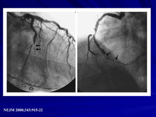 NEJM 2000;343:915-22 