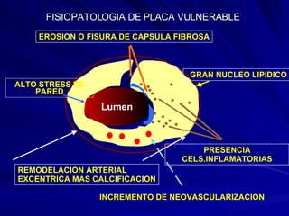 FISIOPATOLOGIA DE PLACA VULNERABLE Lumen EROSION O FISURA DE CAPSULA FIBROSA GRAN NUCLEO LIPIDICO PRESENCIA CELS.INFLAMATORIAS REMODELACION ARTERIAL EXCENTRICA MAS CALCIFICACION ALTO STRESS DE PARED INCREMENTO DE NEOVASCULARIZACION 