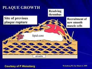 adventitia lipid core lipid core Site of previous plaque rupture Resolving thrombus Recruitment of new smooth muscle cells PLAQUE GROWTH Weissberg PL Eur Heart J. 1999 Courtesy of P Weissberg 
