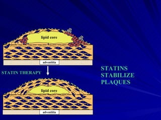 STATINS STABILIZE PLAQUES lipid core adventitia adventitia lipid core STATIN THERAPY 