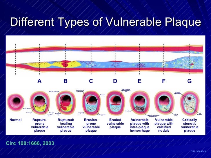 Aterogenesis Dr Fleming