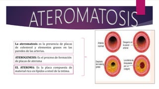EL ATEROMA: Es la placa compuesta de
material rico en lípidos a nivel de la intima.
ATEROGENESIS: Es el proceso de formación
de placas de ateroma
La ateromatosis es la presencia de placas
de colesterol y elementos grasos en las
paredes de las arterias.
 