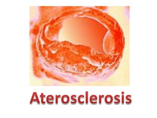 Aterosclerosis   