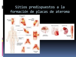 Sitios predispuestos a la
formación de placas de ateroma

 