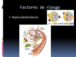 Factores de riesgo
 Hipercolesterolemia

 