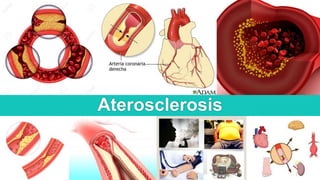 Aterosclerosis
 