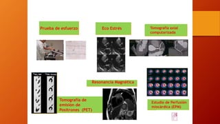 Prueba de esfuerzo Eco Estrés Tomografía axial
computarizada
Resonancia Magnética
Tomografía de
emisión de
Positrones (PET)
Estudio de Perfusión
miocárdica (EPM)
 