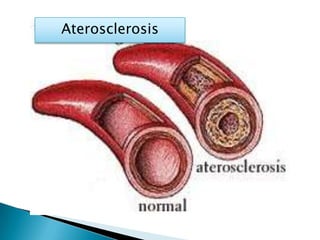 Aterosclerosis 