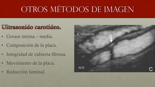 Otros métodos de imagen
•  Grosor íntima – media.
•  Composición de la placa.
•  Integridad de cubierta fibrosa.
•  Movimiento de la placa.
•  Reducción luminal.
 