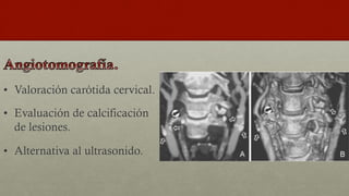 •  Valoración carótida cervical.
•  Evaluación de calcificación
de lesiones.
•  Alternativa al ultrasonido.
 