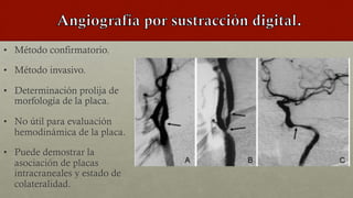 •  Método confirmatorio.
•  Método invasivo.
•  Determinación prolija de
morfología de la placa.
•  No útil para evaluación
hemodinámica de la placa.
•  Puede demostrar la
asociación de placas
intracraneales y estado de
colateralidad.
 