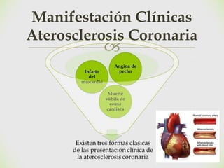🙢
Manifestación Clínicas
Aterosclerosis Coronaria
 
