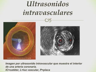 🙢
Ultrasonidos
intravasculares
Imagen por ultrasonido intravascular que muestra el interior
de una arteria coronaria.
IC=catéter, L=luz vascular, P=placa
 