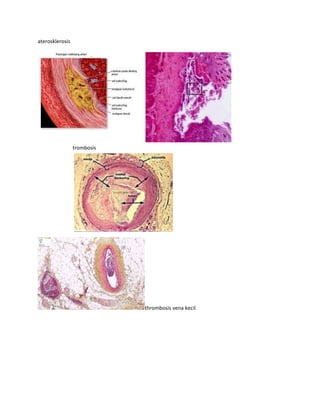 aterosklerosis

trombosis

thrombosis vena kecil

 