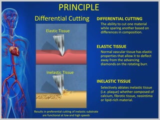 Differential Cutting DIFFERENTIAL CUTTING
The ability to cut one material
while sparing another based on
differences in composition.
ELASTIC TISSUE
Normal vascular tissue has elastic
properties that allow it to deflect
away from the advancing
diamonds on the rotating burr.
INELASTIC TISSUE
Selectively ablates inelastic tissue
(i.e. plaque) whether composed of
calcium, fibrotic tissue, neointima
or lipid-rich material.
Elastic Tissue
Inelastic Tissue
Results in preferential cutting of inelastic substrate
are functional at low and high speeds
PRINCIPLE
 