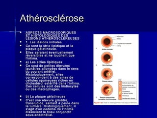 AAtthhéérroosscclléérroossee 
 AASSPPEECCTTSS MMAACCRROOSSCCOOPPIIQQUUEESS 
EETT HHIISSTTOOLLOOGGIIQQUUEESS DDEESS 
LLÉÉSSIIOONNSS AATTHHÉÉRROOSSCCLLÉÉRREEUUSSEESS 
 11.. LLeess llééssiioonnss iinniittiiaalleess 
 CCee ssoonntt llaa ssttrriiee lliippiiddiiqquuee eett llaa 
ppllaaqquuee ggééllaattiinneeuussee.. 
 EElllleess sseerraaiieenntt éévveennttuueelllleemmeenntt 
rréévveerrssiibblleess eett nnee ttoouucchheenntt qquuee 
ll''iinnttiimmaa.. 
 aa)) LLeess ssttrriieess lliippiiddiiqquueess 
 CCee ssoonntt ddee ppeettiitteess éélleevvuurreess 
jjaauunnââttrreess aalllloonnggééeess ddaannss llee sseennss 
dduu ccoouurraanntt aarrttéérriieell.. 
HHiissttoollooggiiqquueemmeenntt,, eelllleess 
ccoorrrreessppoonnddeenntt àà ddeess aammaass ddee 
cceelllluulleess ssppuummeeuusseess rriicchheess eenn 
cchhoolleessttéérrooll eessttéérriiffiiéé ddaannss ll''iinnttiimmaa.. 
CCeess cceelllluulleess ssoonntt ddeess hhiissttiiooccyytteess 
oouu ddeess mmaaccrroopphhaaggeess.. 
 bb)) LLaa ppllaaqquuee ggééllaattiinneeuussee 
 CC''eesstt uunnee éélleevvuurree ggrriissââttrree,, 
ttrraannsslluucciiddee,, ssaaiillllaanntt àà ppeeiinnee ddaannss 
llaa lluummiièèrree.. HHiissttoollooggiiqquueemmeenntt,, iill 
ss''aaggiitt dd''uunn ooeeddèèmmee ddee ll''iinnttiimmaa 
ddiissssoocciiaanntt llee ttiissssuu ccoonnjjoonnccttiiff 
ssoouuss­­eennddootthhéélliiaall.. 
 